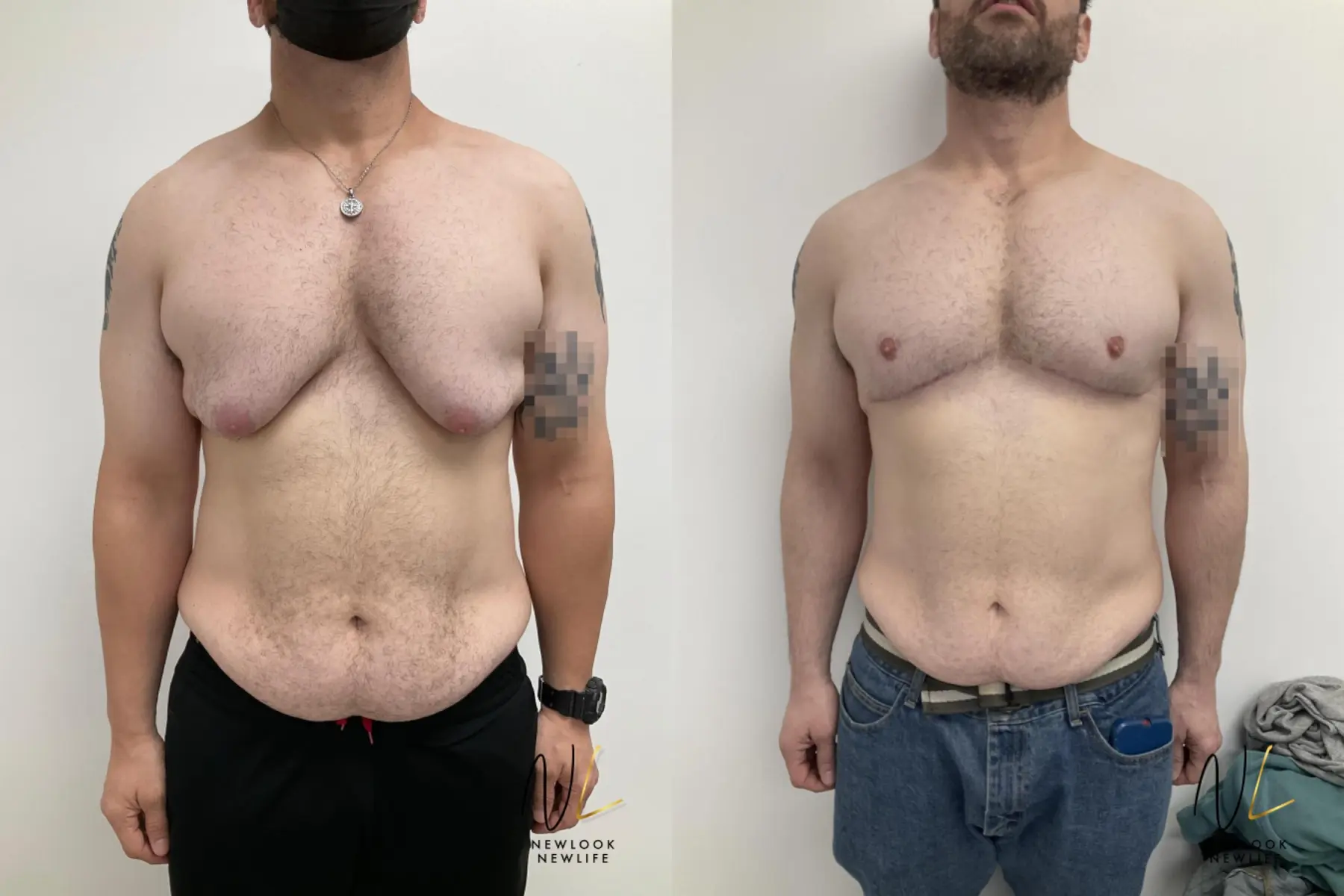 Gynecomastia: Patient 8 - Before and After  