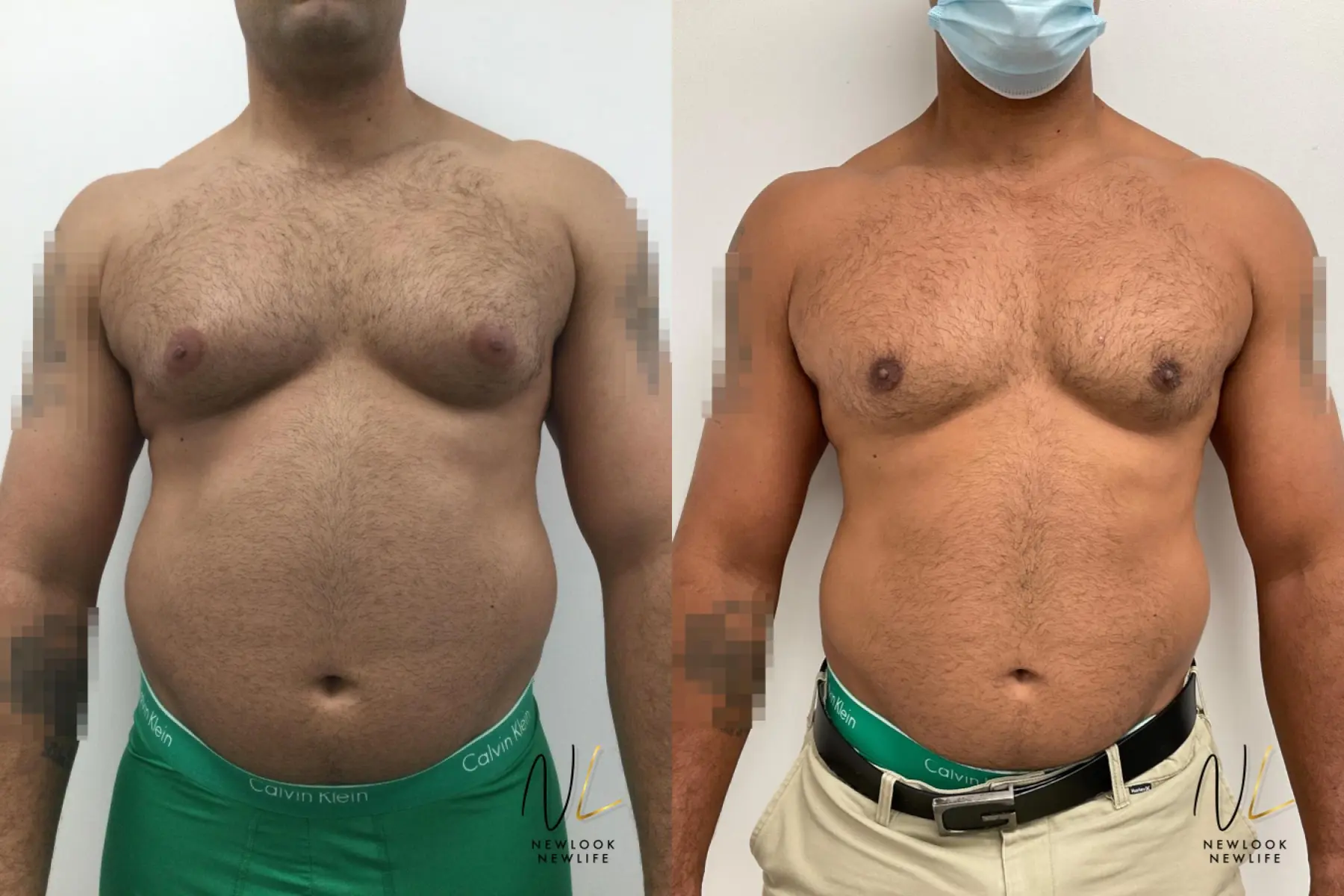 Gynecomastia: Patient 1 - Before and After  