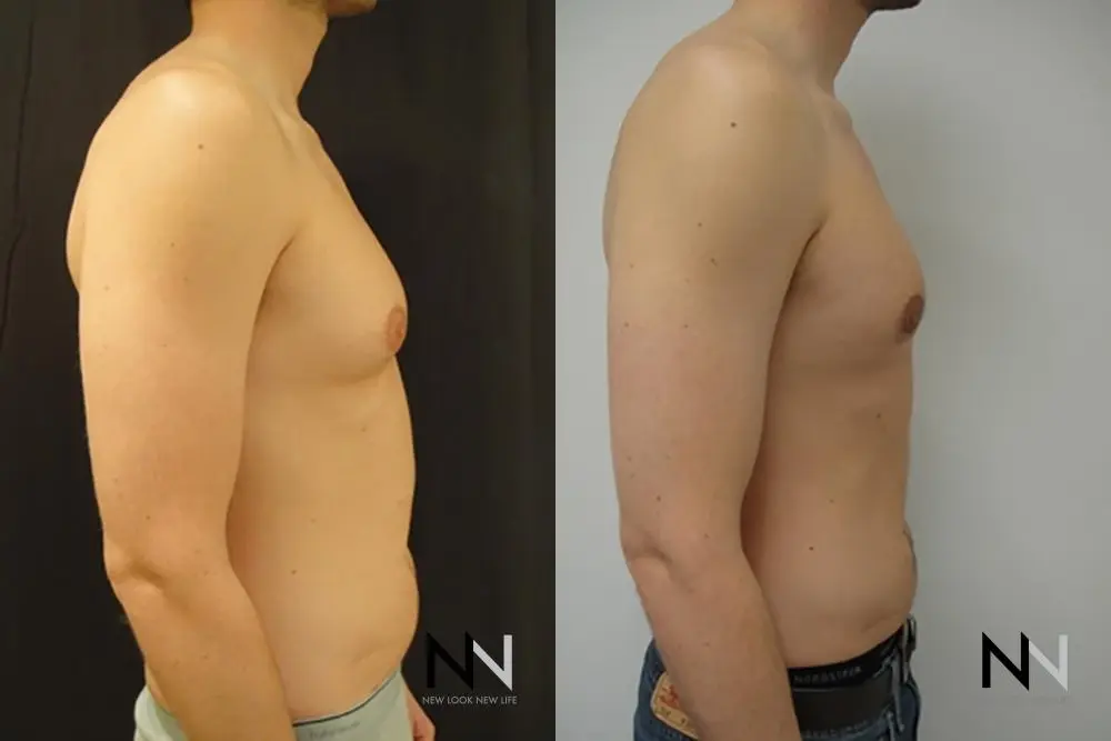 Gynecomastia: Patient 18 - Before and After 5