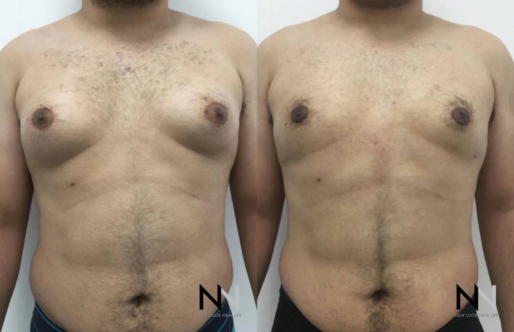 Gynecomastia: Patient 16 - Before and After 1