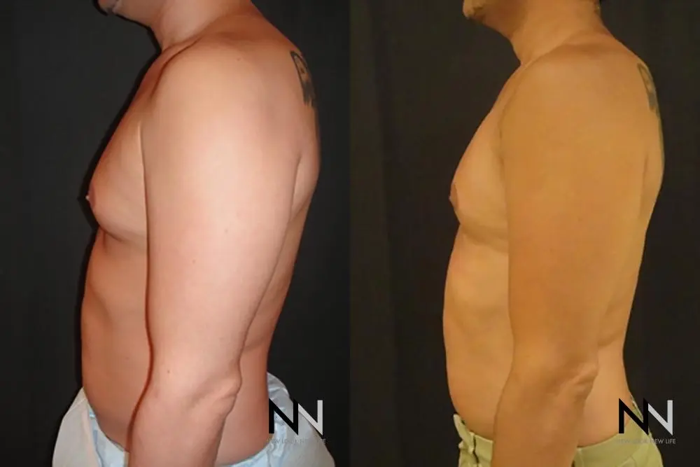 Gynecomastia: Patient 15 - Before and After 4