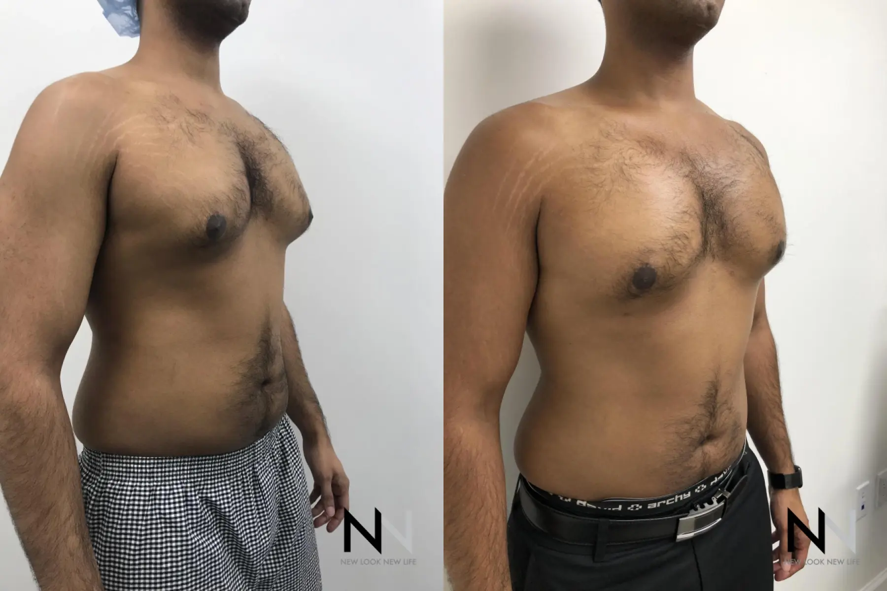 Gynecomastia: Patient 7 - Before and After 4