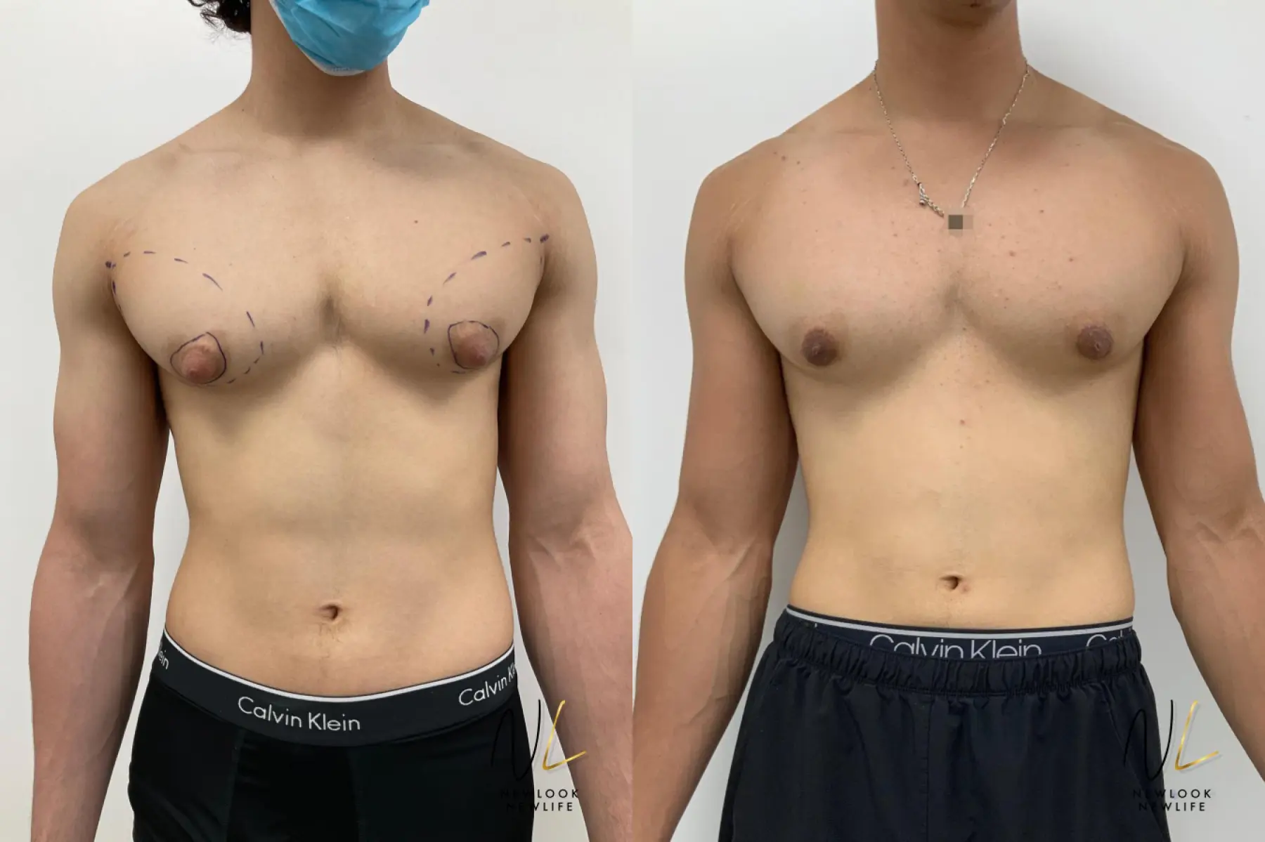 Gynecomastia: Patient 2 - Before and After  