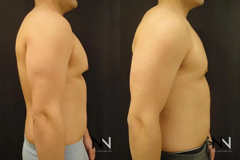 Gynecomastia: Patient 12 - Before and After 5