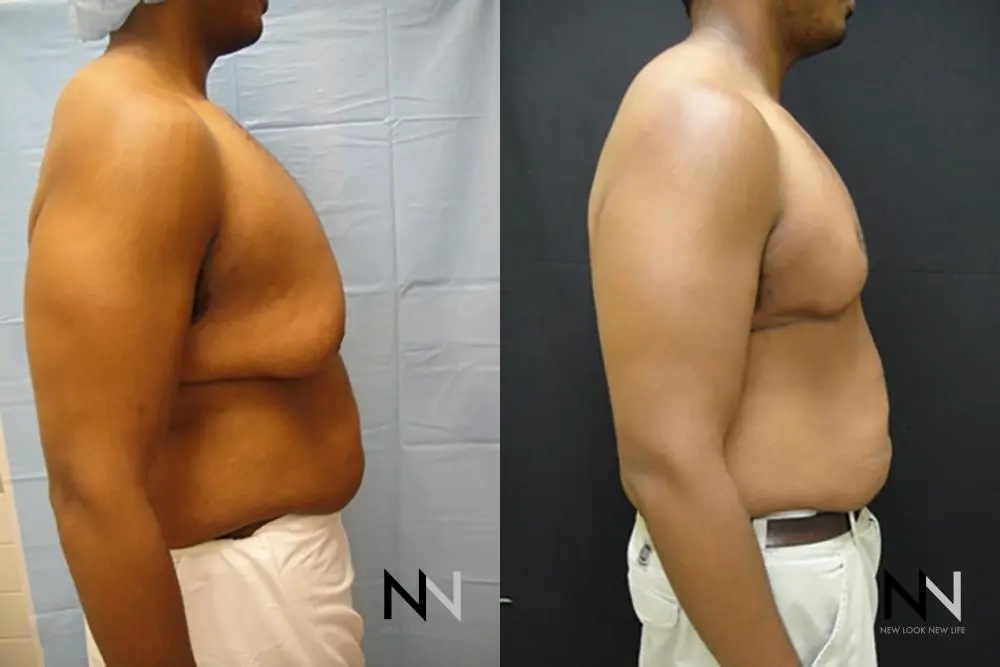 Gynecomastia: Patient 17 - Before and After 5