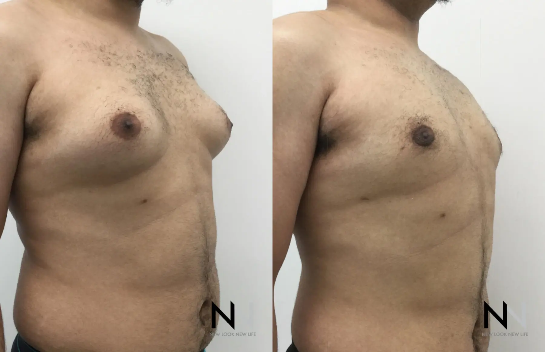 Gynecomastia: Patient 16 - Before and After 4