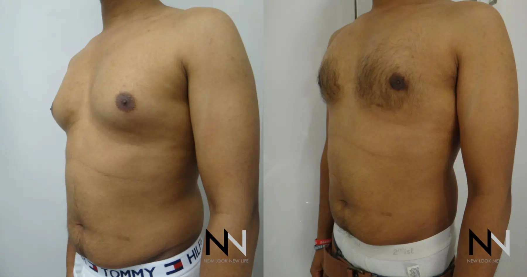 Gynecomastia: Patient 20 - Before and After 2