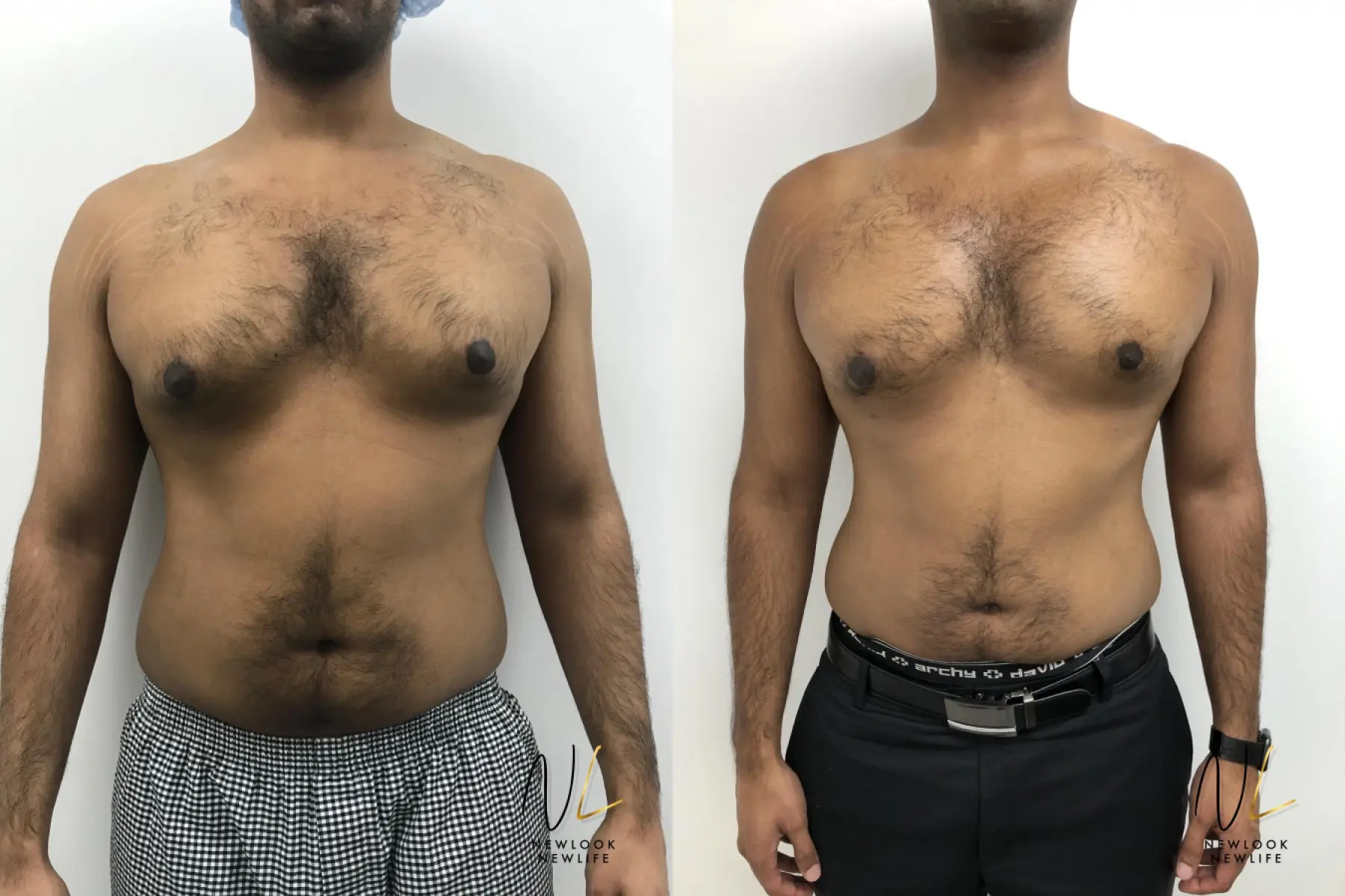 Gynecomastia: Patient 7 - Before and After  