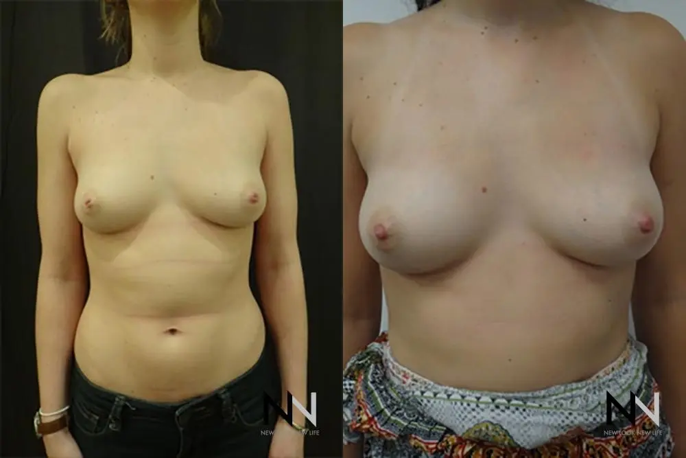 Inverted Nipple Surgery: Patient 3 - Before and After  