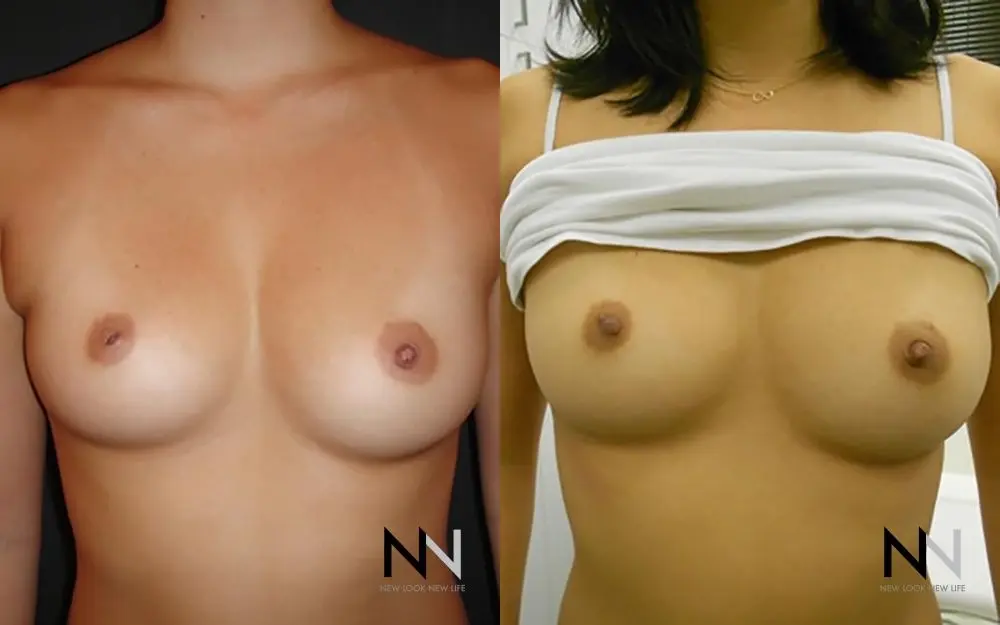 Inverted Nipple Surgery: Patient 1 - Before and After  