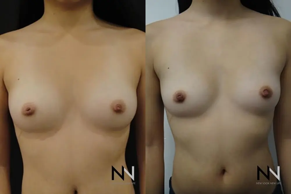 Inverted Nipple Surgery: Patient 2 - Before and After  