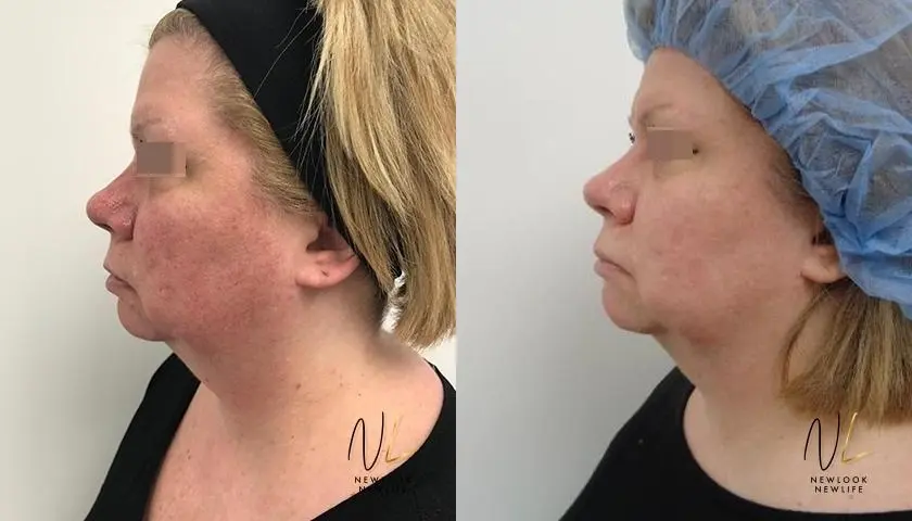 Laser: Patient 4 - Before and After  