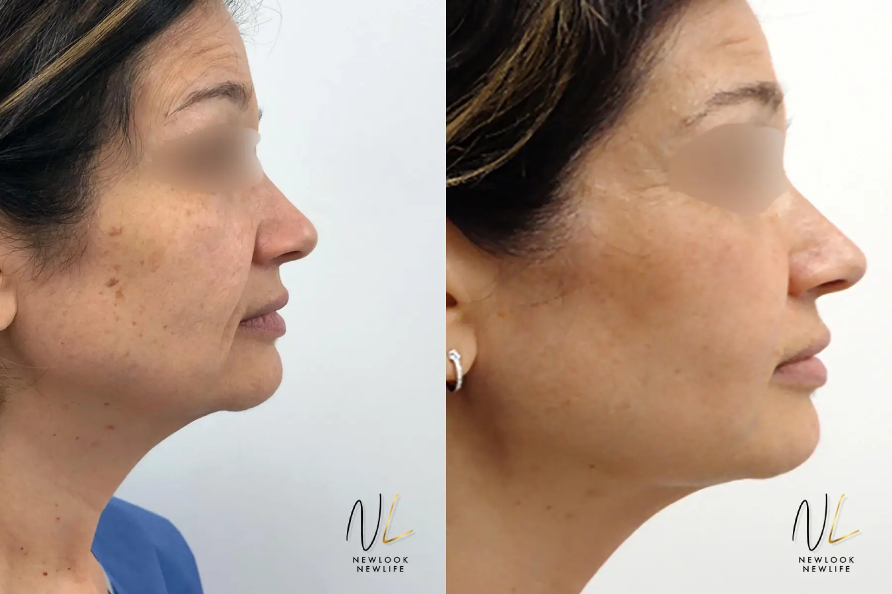 Laser: Patient 1 - Before and After 2