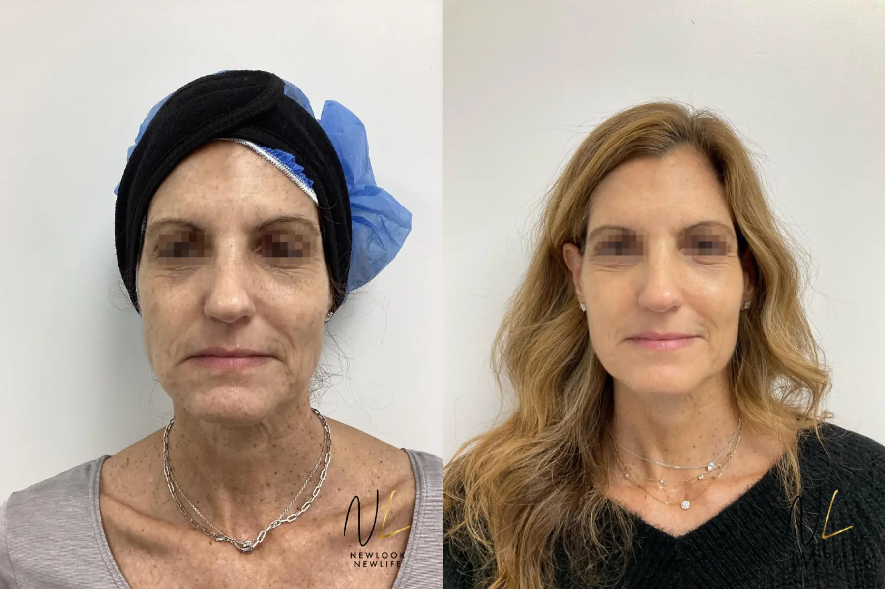 Laser: Patient 3 - Before and After 3