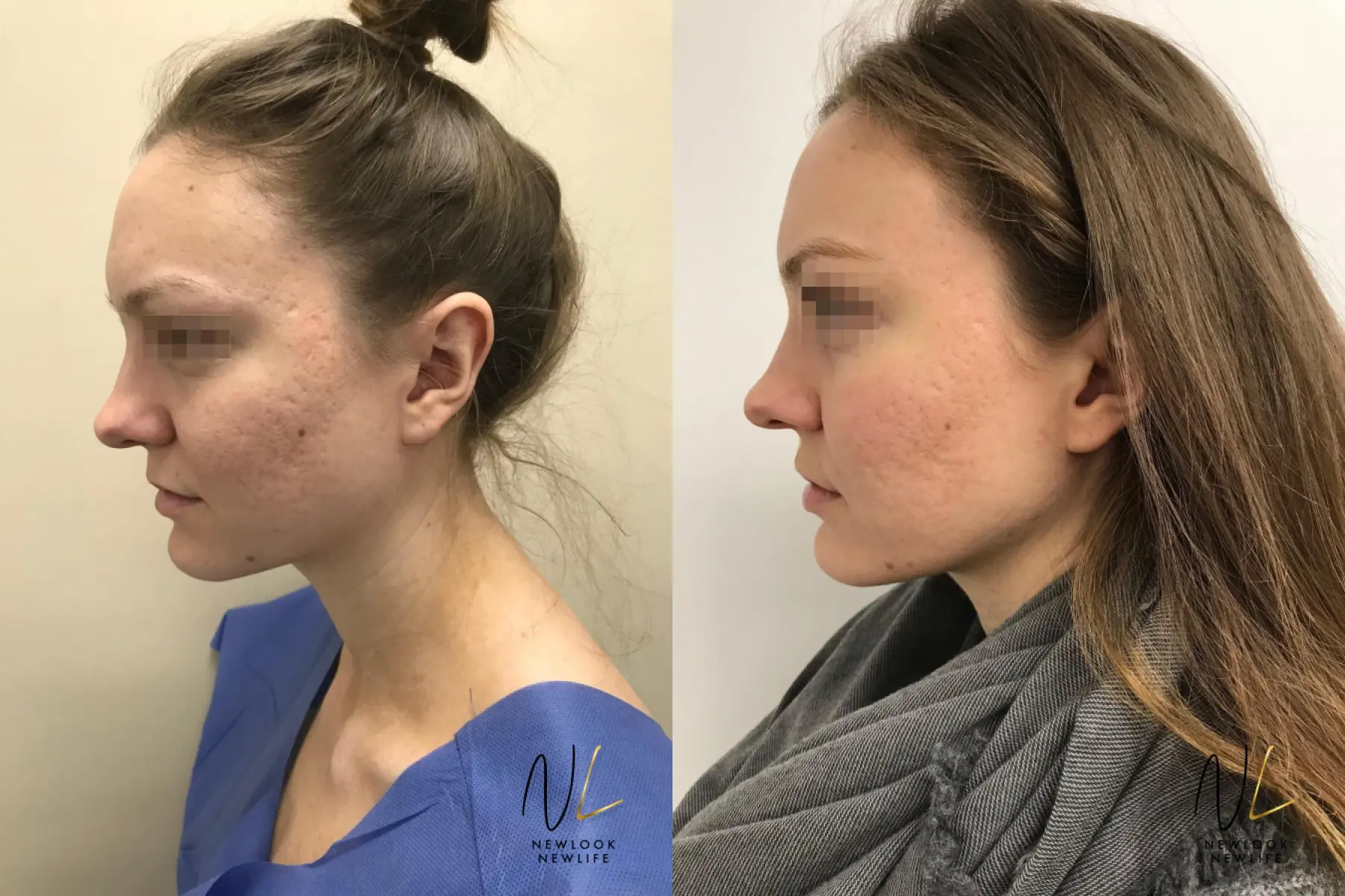 Laser: Patient 9 - Before and After  