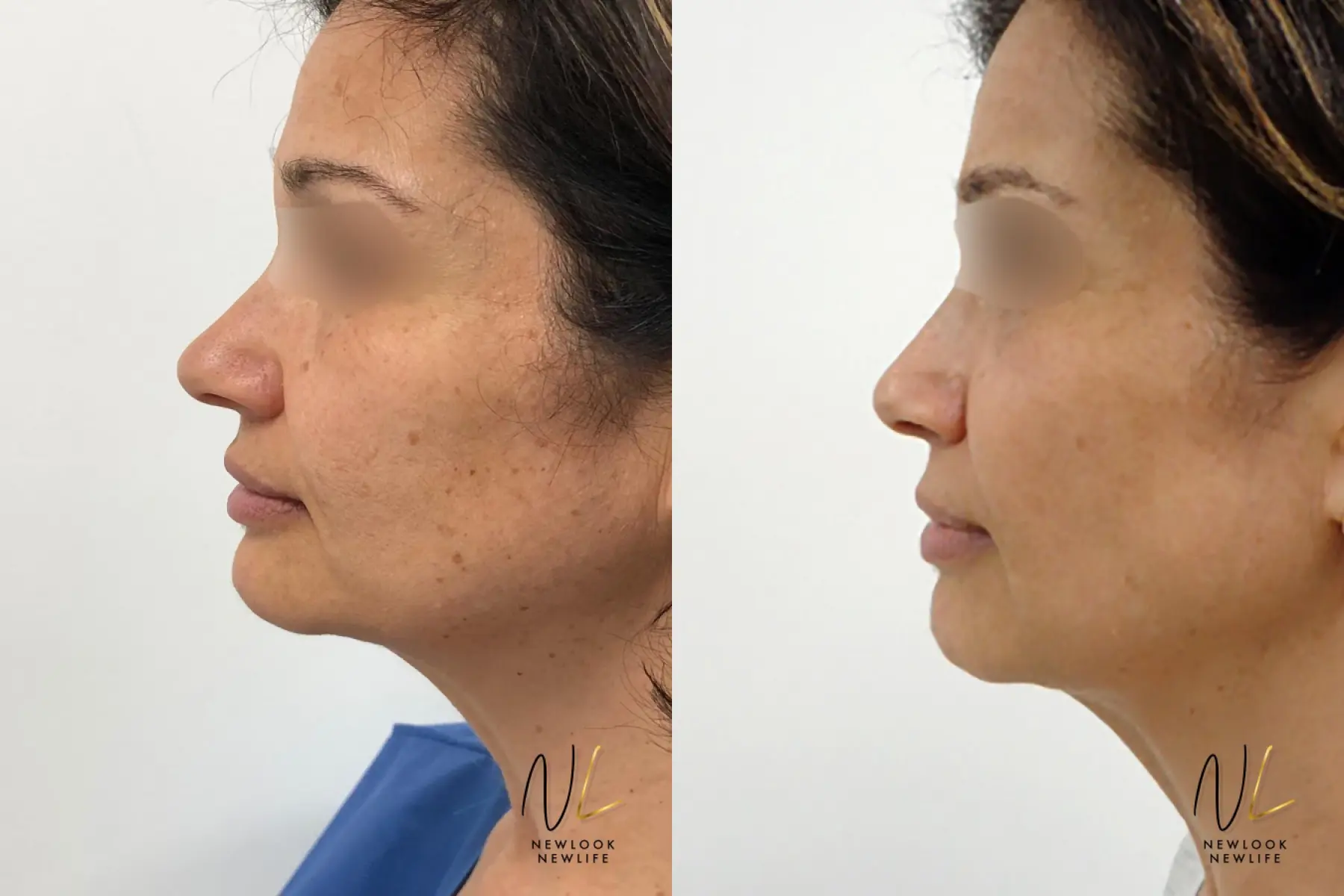 Laser: Patient 1 - Before and After 3