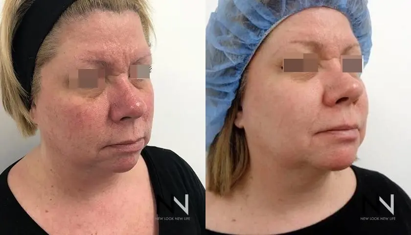 Laser: Patient 4 - Before and After 2