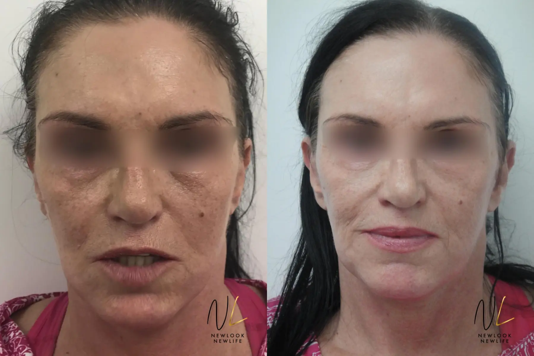 Laser: Patient 2 - Before and After 3