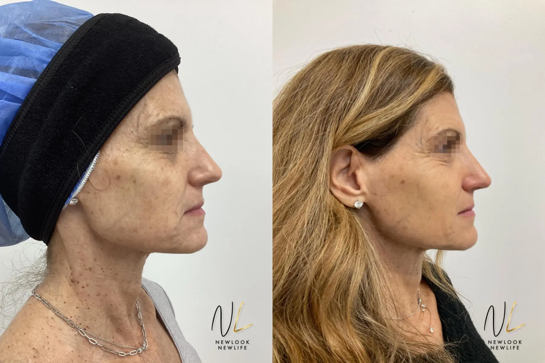 Laser: Patient 3 - Before and After  