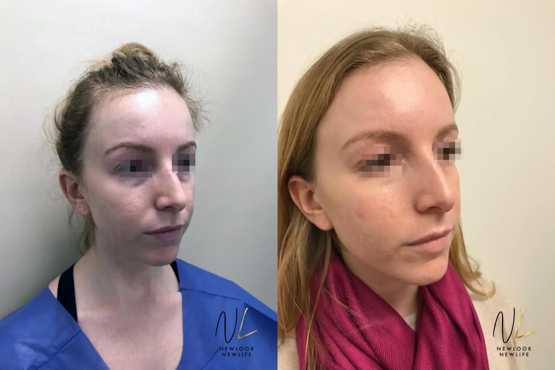 Laser: Patient 5 - Before and After 2