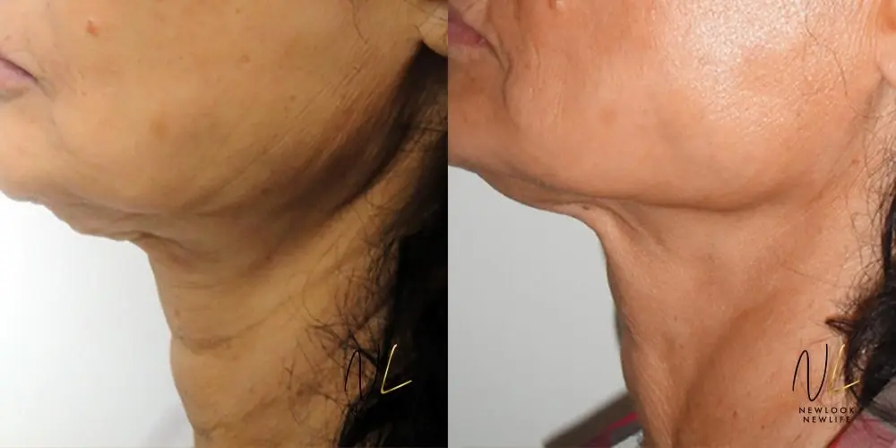 Laser: Patient 19 - Before and After 2