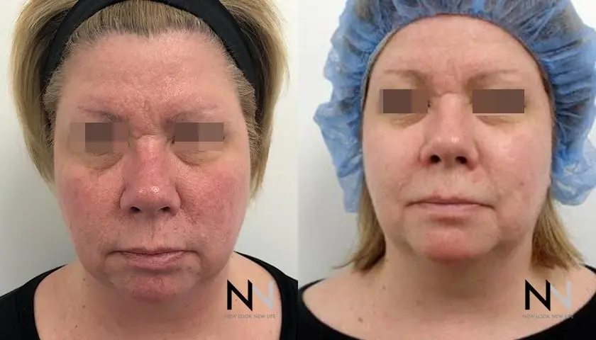 Laser: Patient 4 - Before and After 5