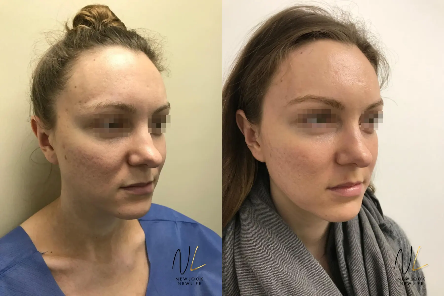 Laser: Patient 9 - Before and After 4