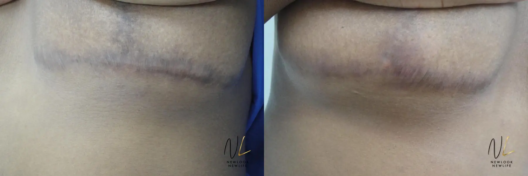 Laser: Patient 16 - Before and After 2