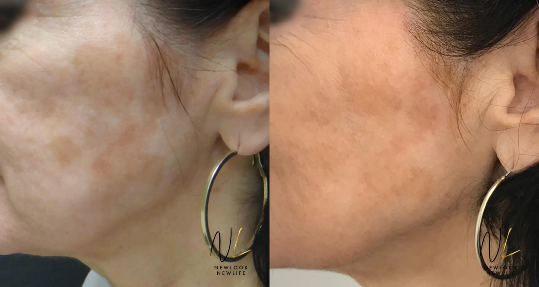 Laser: Patient 12 - Before and After 1