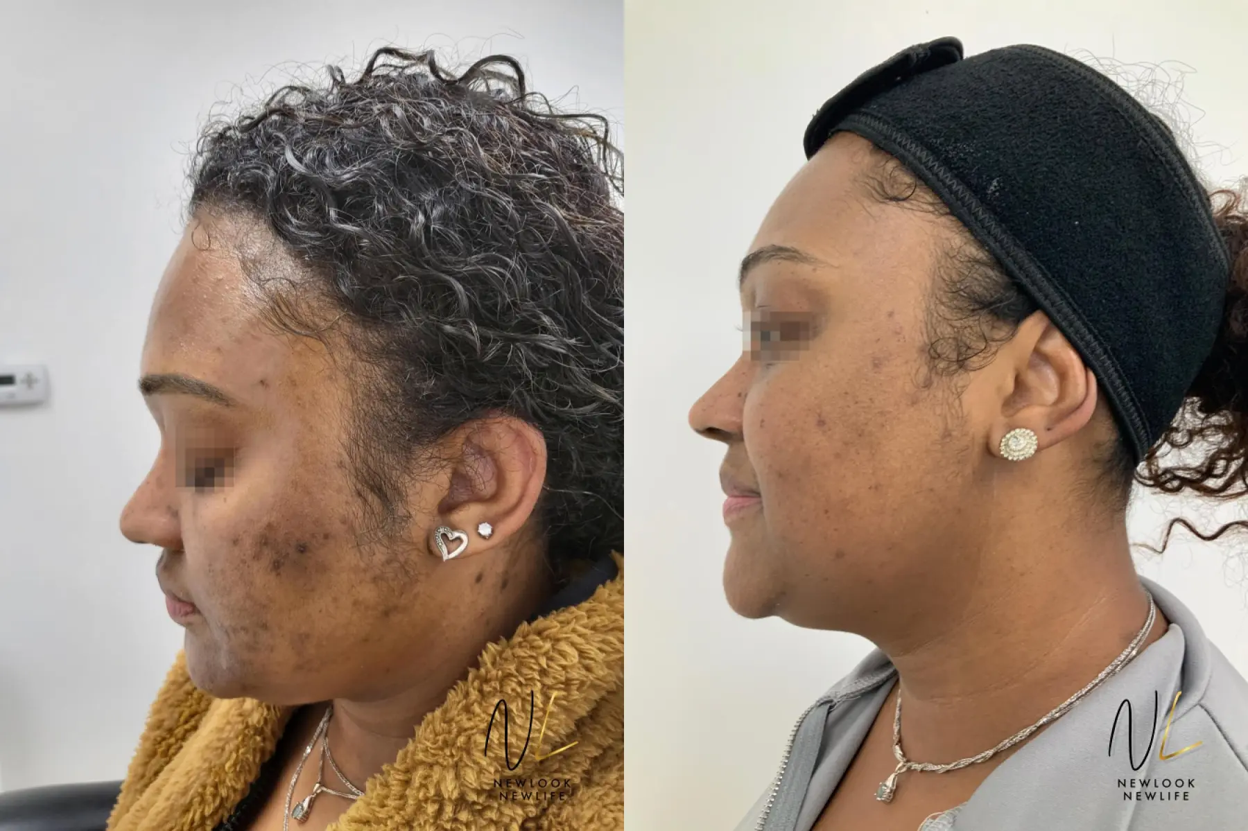 Laser: Patient 17 - Before and After 2