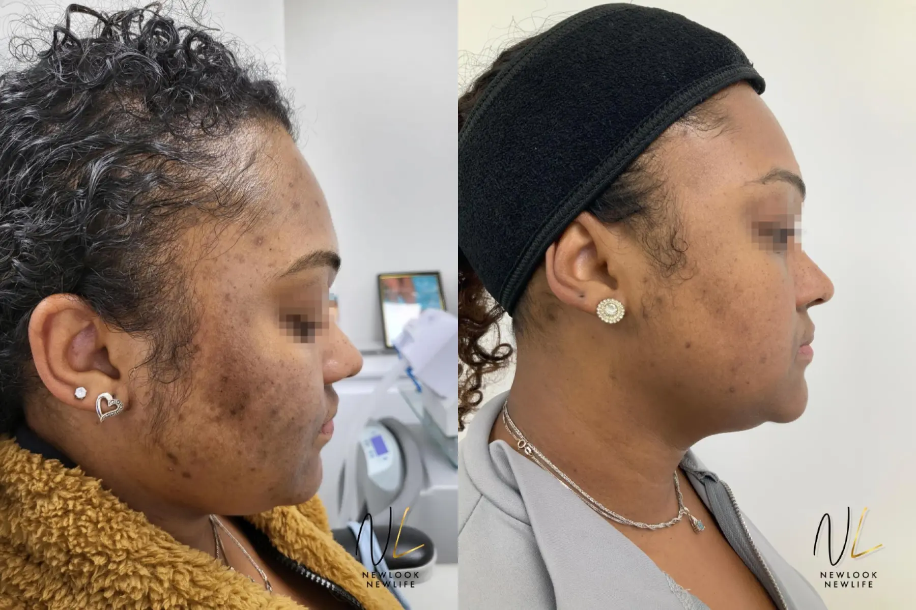 Laser: Patient 17 - Before and After 3