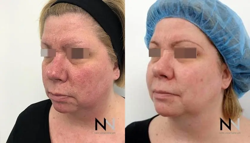 Laser: Patient 4 - Before and After 3