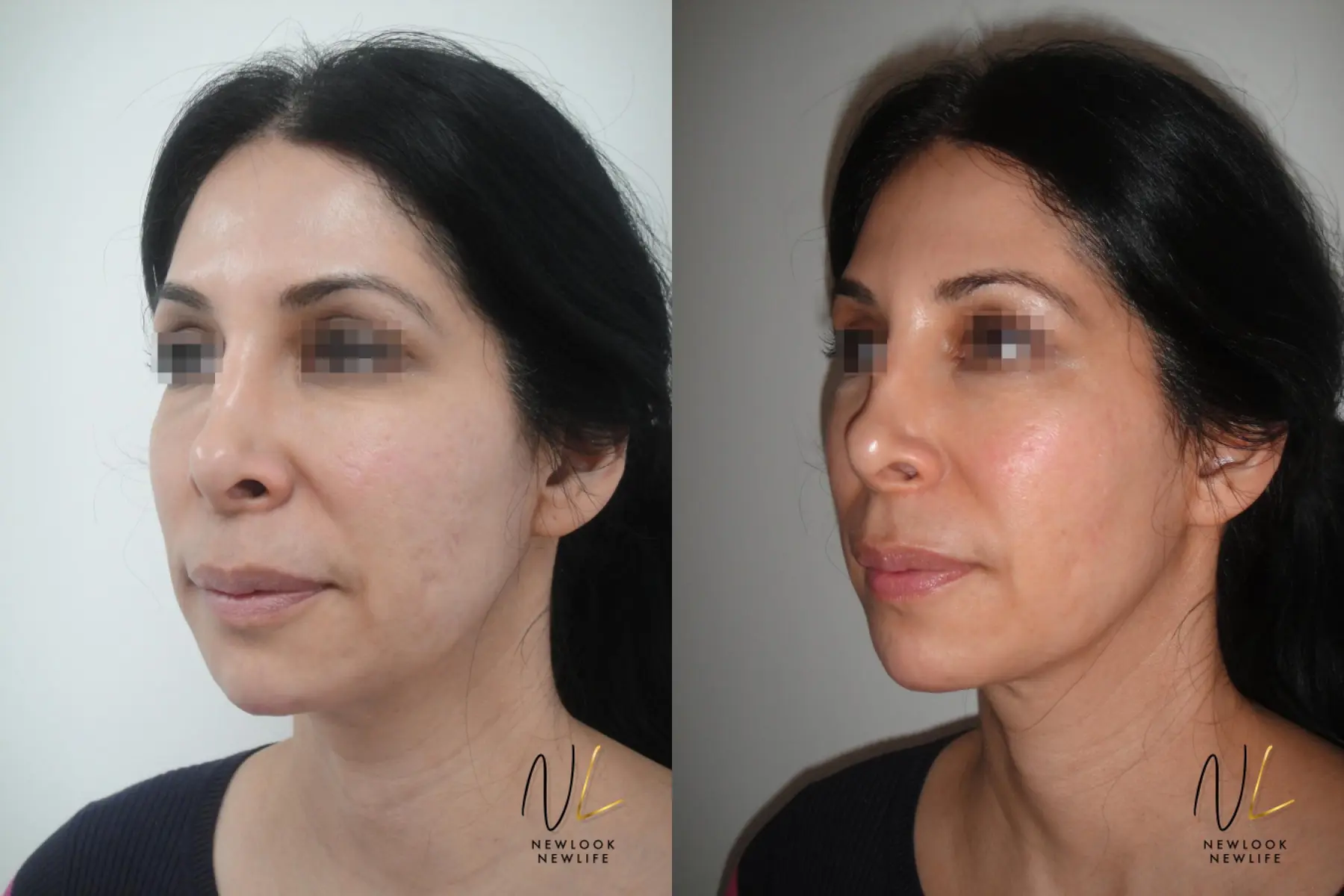 Laser: Patient 7 - Before and After 1