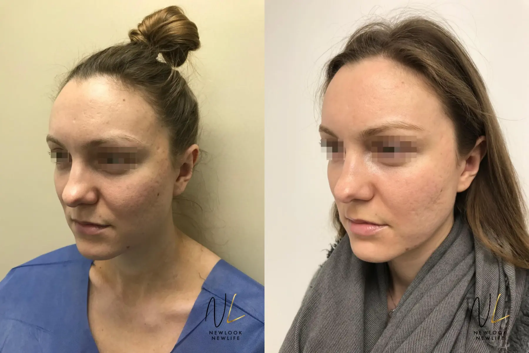 Laser: Patient 9 - Before and After 3