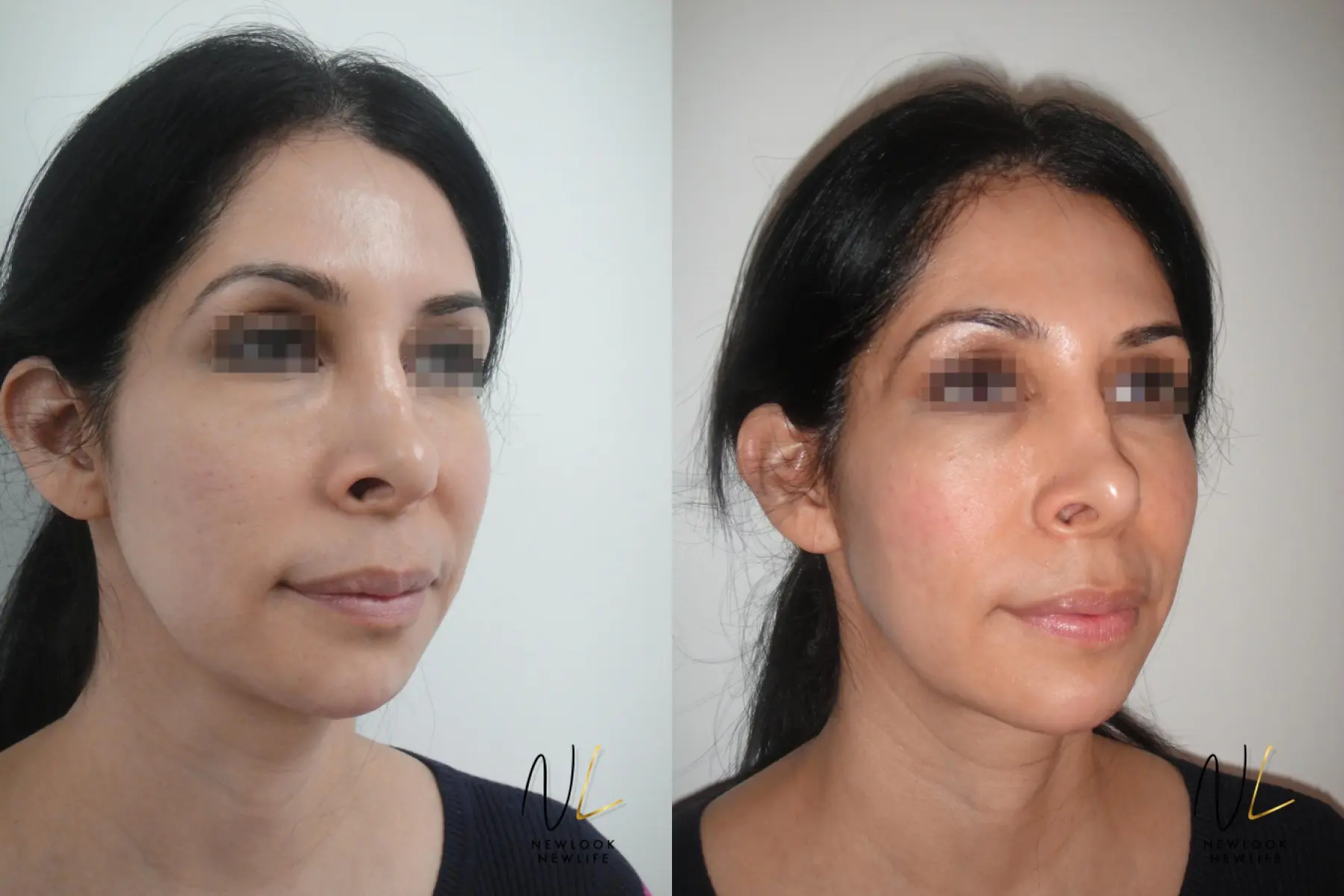 Laser: Patient 7 - Before and After 2