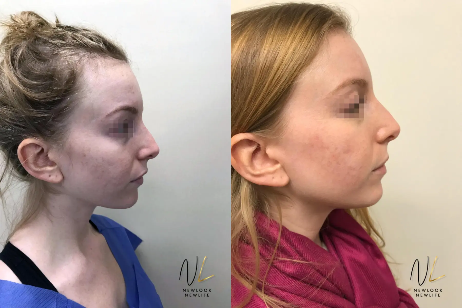 Laser: Patient 5 - Before and After 3