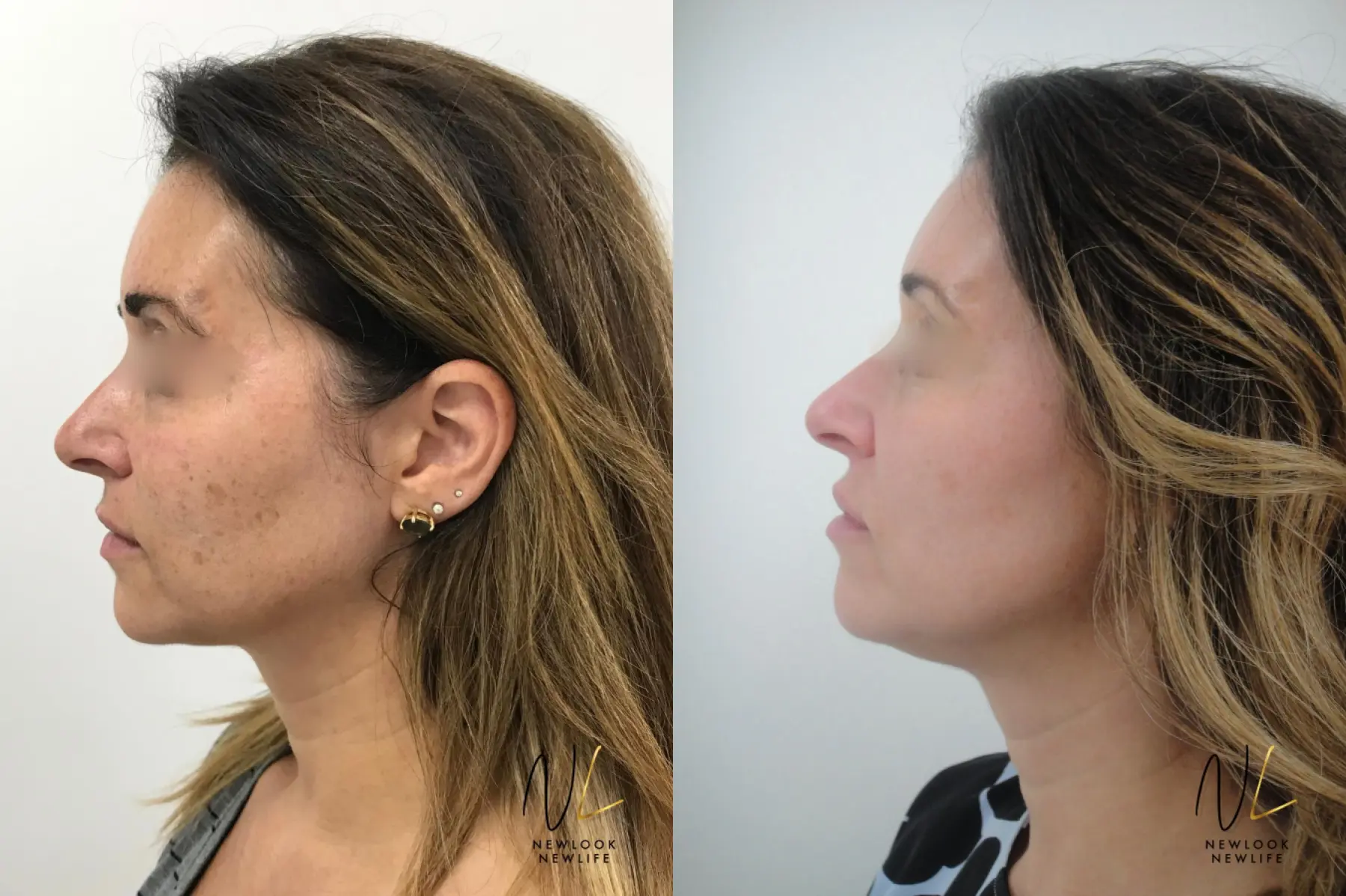 Laser: Patient 8 - Before and After 2