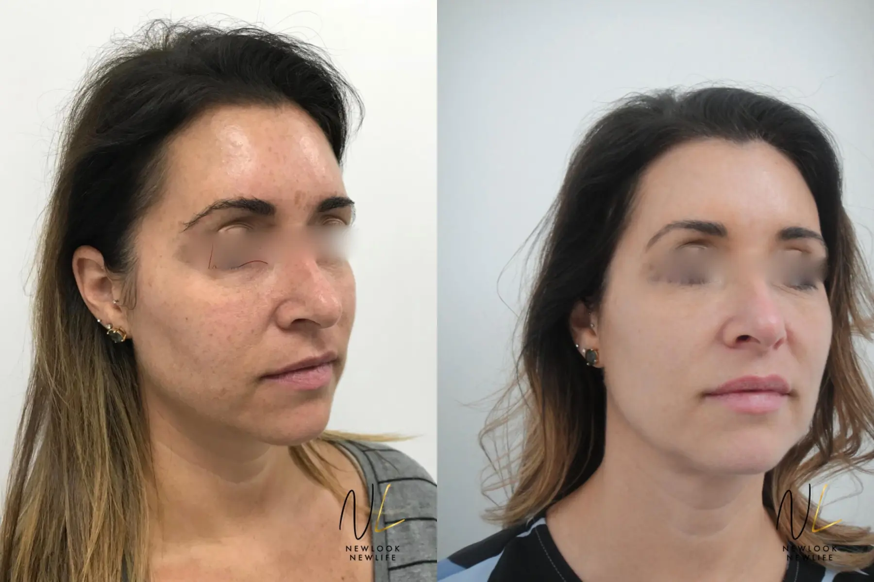 Laser: Patient 8 - Before and After 4