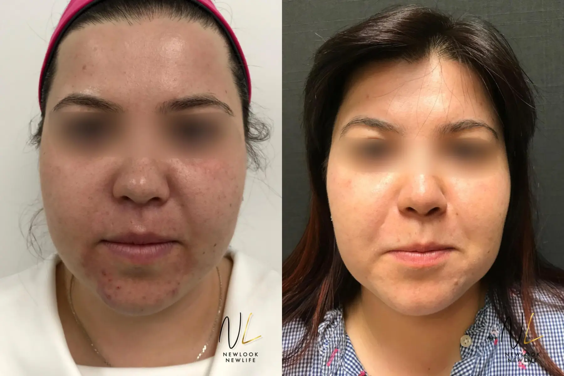 Laser: Patient 11 - Before and After 1