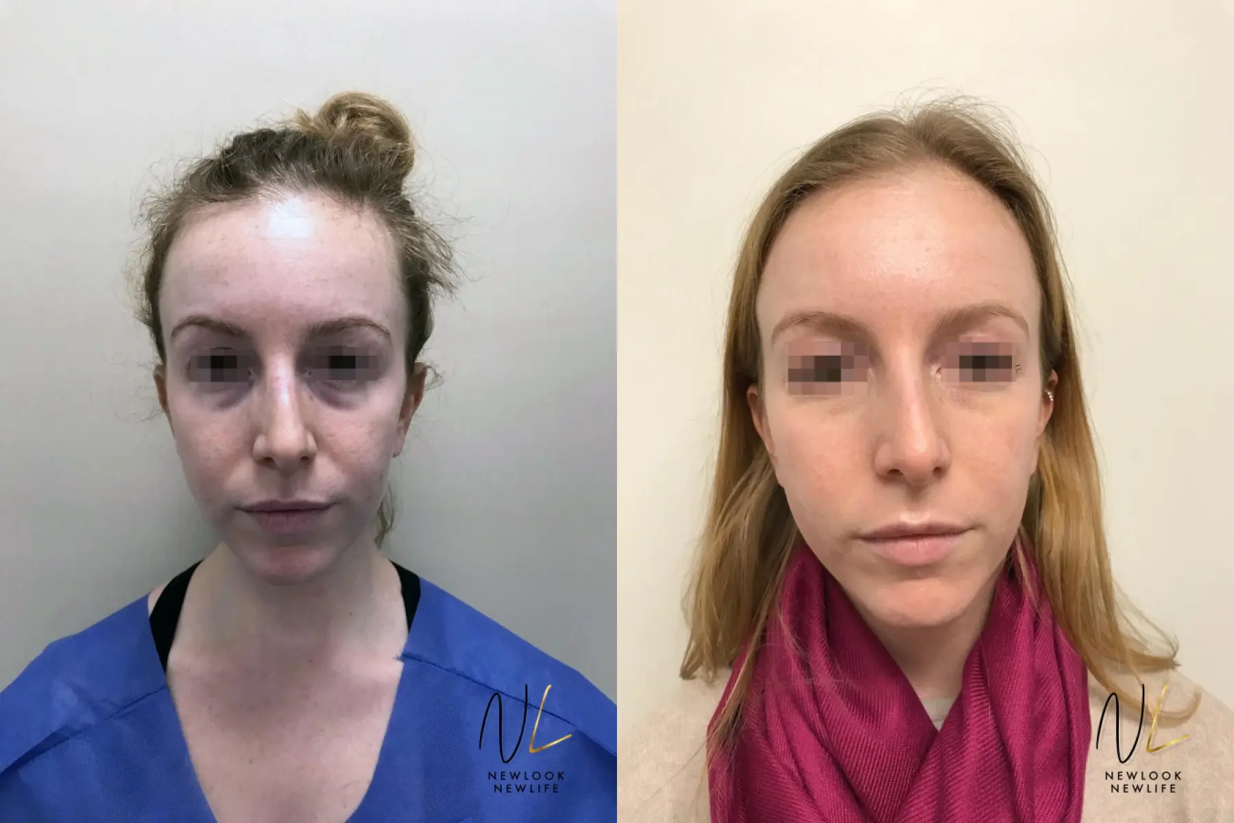 Laser: Patient 5 - Before and After  