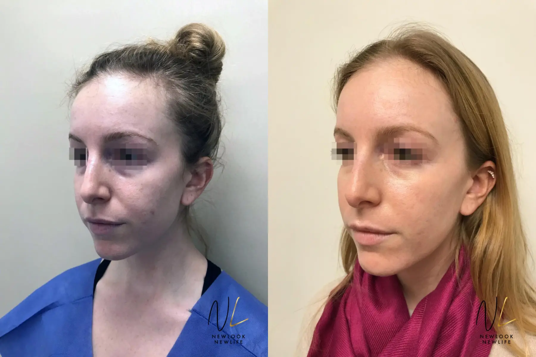 Laser: Patient 5 - Before and After 4