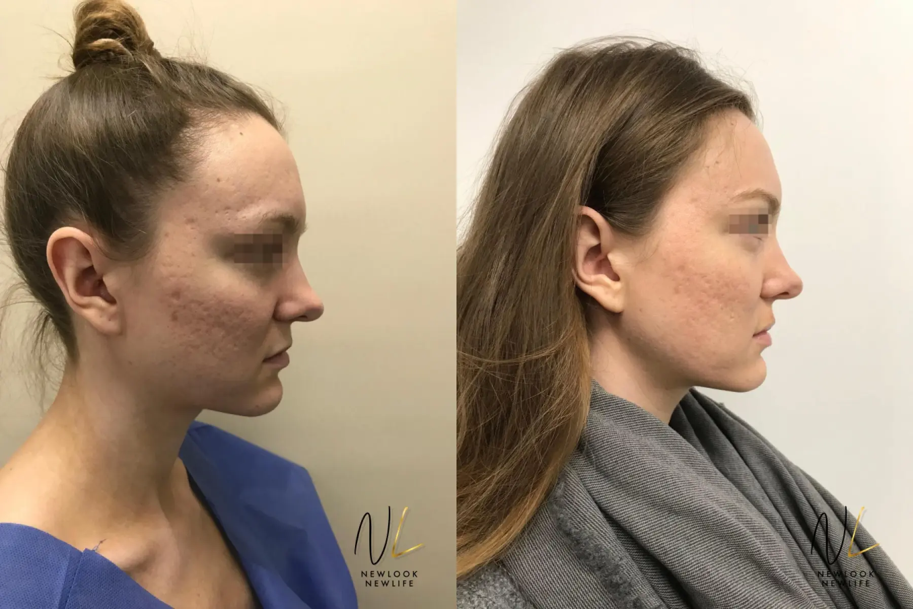 Laser: Patient 9 - Before and After 2