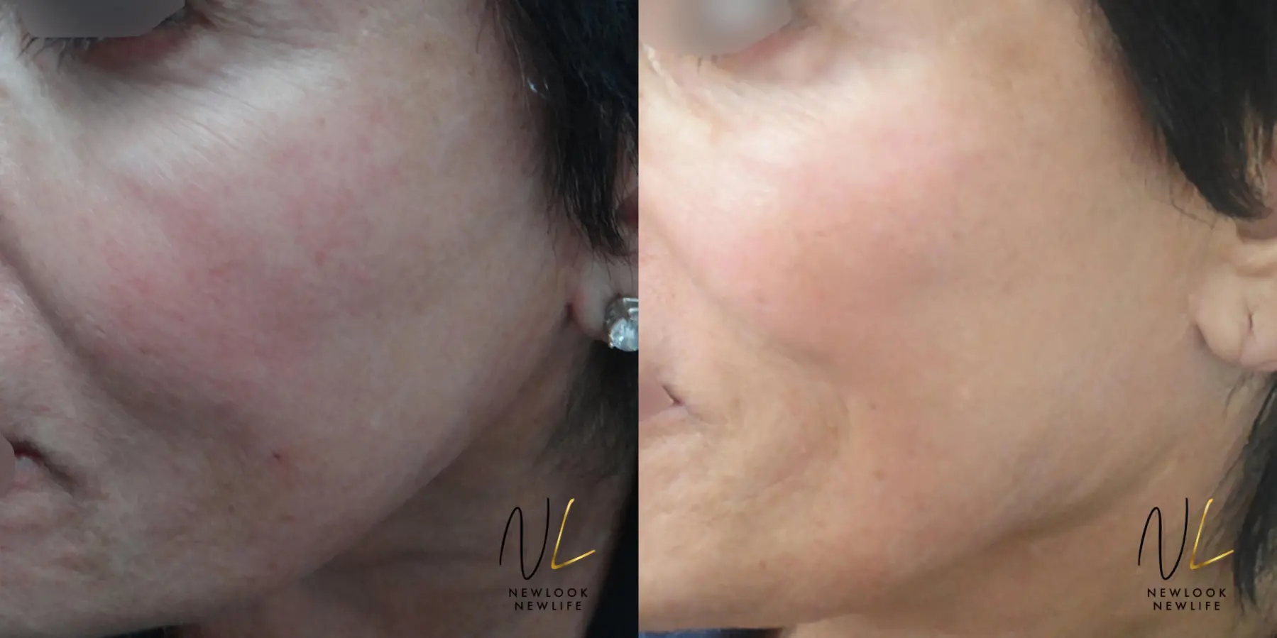 Laser: Patient 10 - Before and After 1