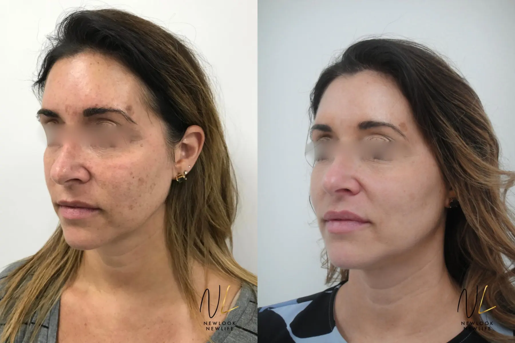 Laser: Patient 8 - Before and After 5