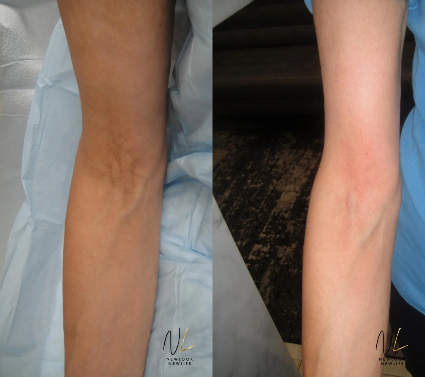 Laser: Patient 18 - Before and After  