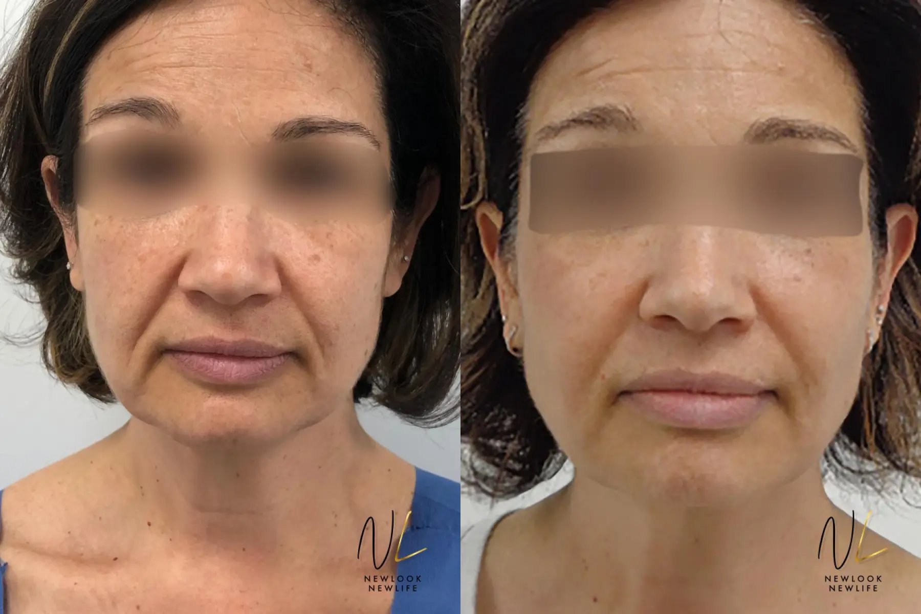 Laser: Patient 1 - Before and After  