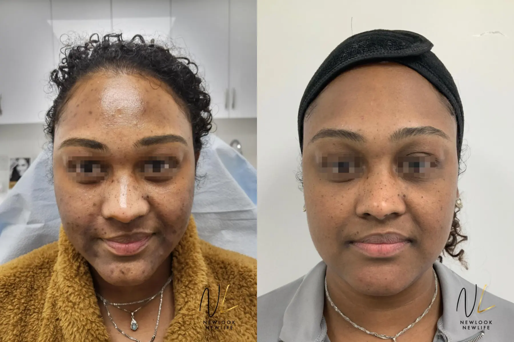 Laser: Patient 17 - Before and After  