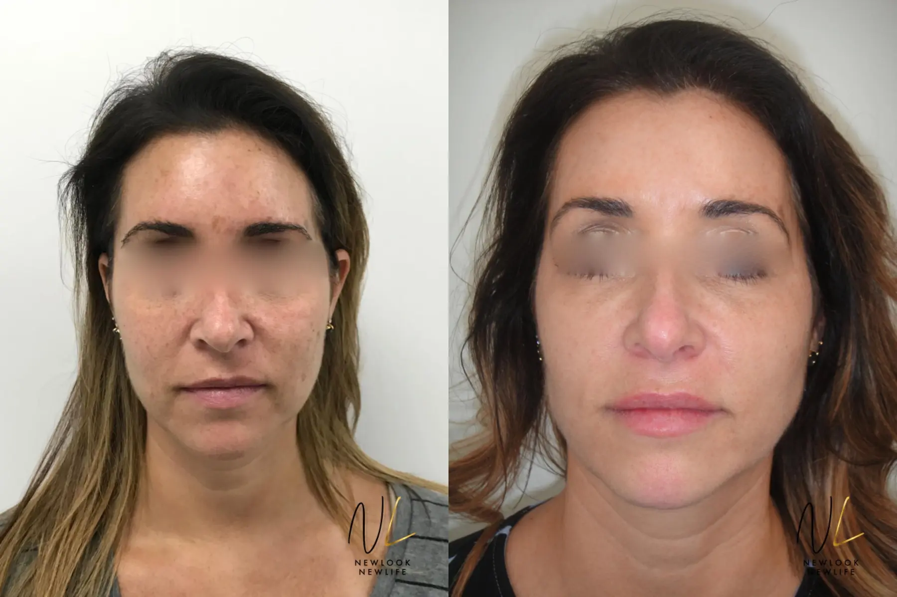 Laser: Patient 8 - Before and After 1