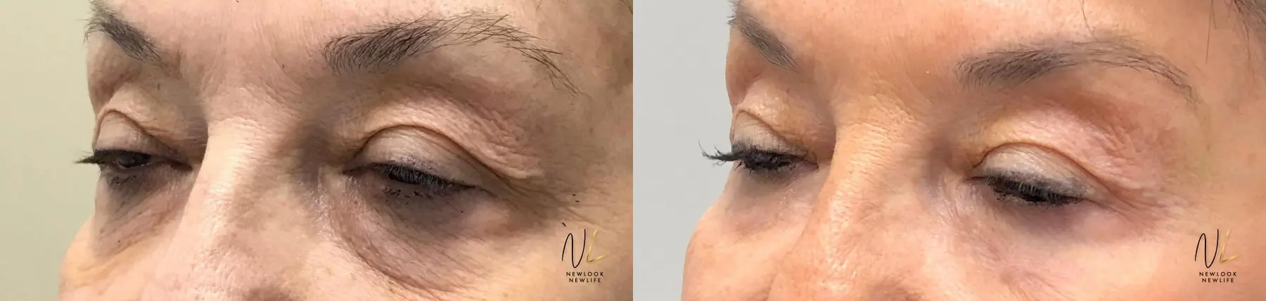 Laser: Patient 14 - Before and After 1