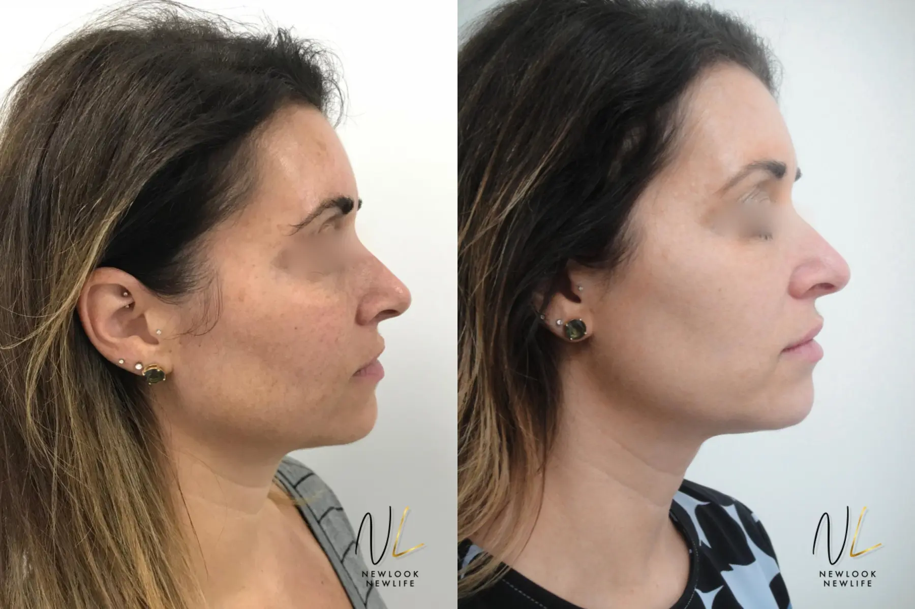 Laser: Patient 8 - Before and After 3